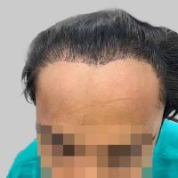 repair hair transplant