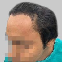 repair hair transplant
