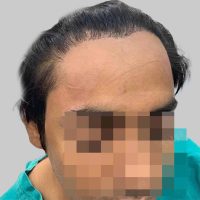 repair hair transplant