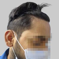 repair hair transplant