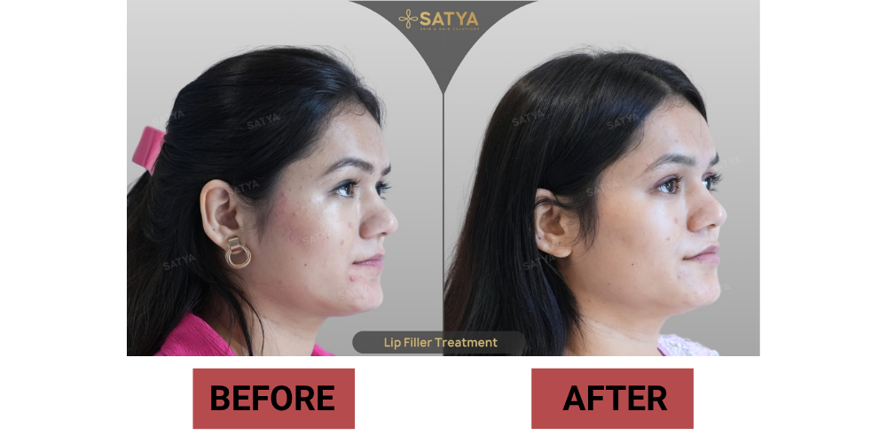 Eyebrow Transplant Cost in India