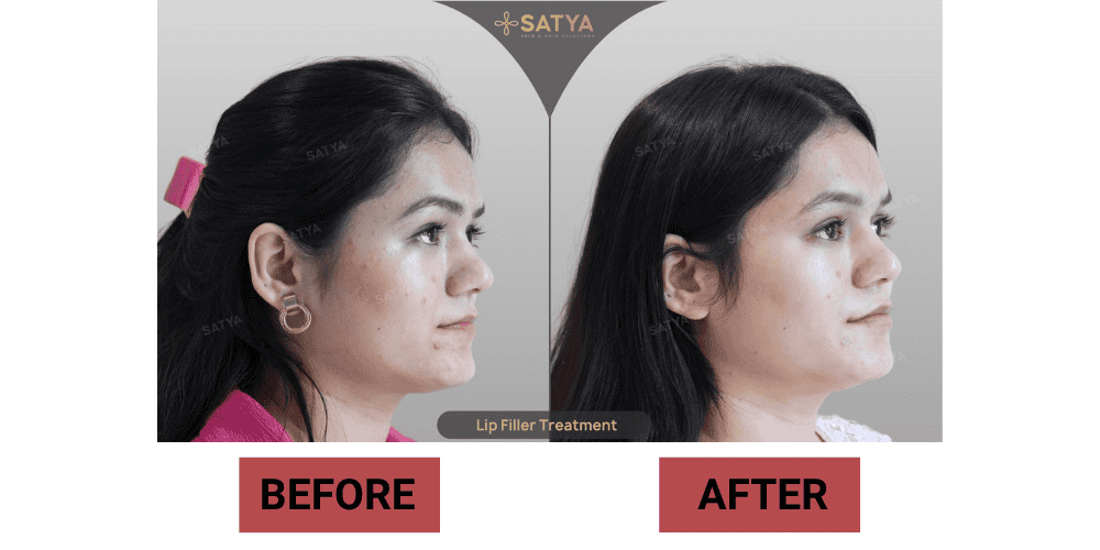 Eyebrow Transplant Cost in India