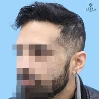 synthetic hair implant