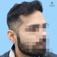 synthetic hair implant