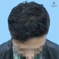 synthetic hair implant