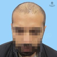 synthetic hair implant