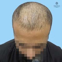 synthetic hair implant