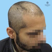 synthetic hair implant